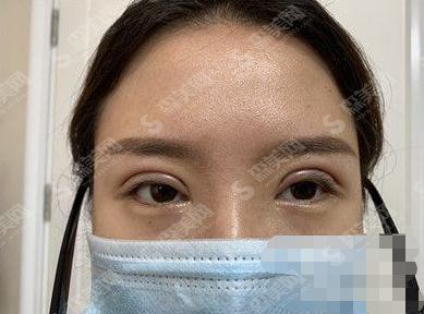 铜雀台整形医院李信奎双眼皮做的怎么样？专家案例_价格收费标准