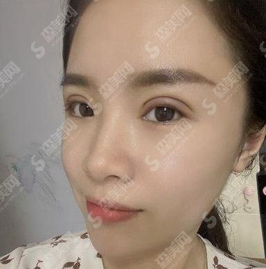 铜雀台整形医院李信奎双眼皮做的怎么样？专家案例_价格收费标准