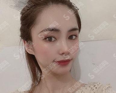 郑州大学第五附属医院徐杨阳隆鼻做的如何,案例直击速看