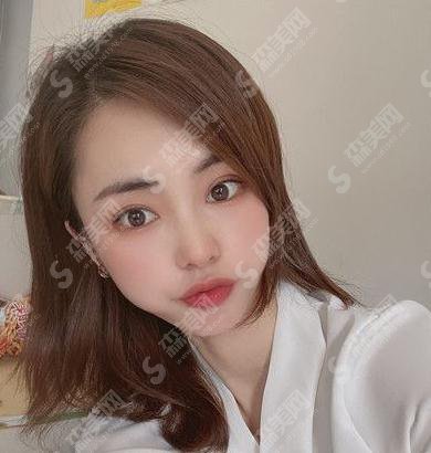 郑州大学第五附属医院徐杨阳隆鼻做的如何,案例直击速看