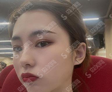 郑州大学第五附属医院徐杨阳隆鼻做的如何,案例直击速看