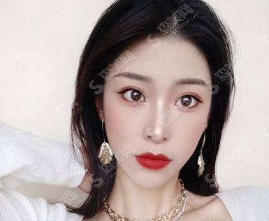 陕西省人民医院慕生枝切开双眼皮技术好吗？案例供参～价格公布