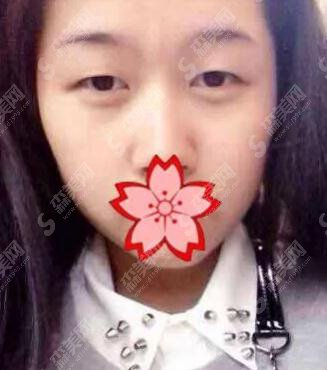 南宁华美整形医院双眼皮专家刘真俊案例直击速看~个人简介~口碑评价