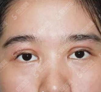 南宁华美整形医院双眼皮专家刘真俊案例直击速看~个人简介~口碑评价