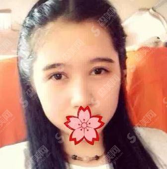 南宁华美整形医院双眼皮专家刘真俊案例直击速看~个人简介~口碑评价