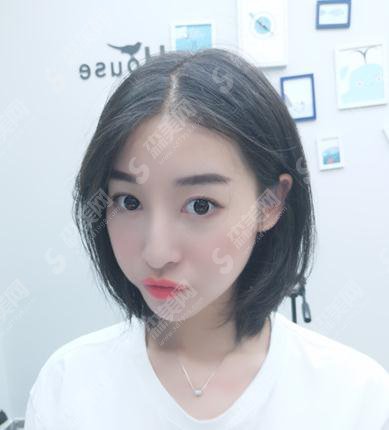 湖南长沙人民医院李高峰双眼皮价格表出炉了，含整形案例恢复对比照