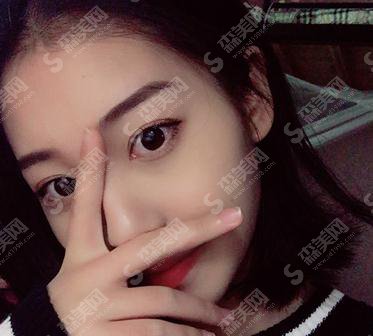 湖南长沙人民医院李高峰双眼皮价格表出炉了，含整形案例恢复对比照