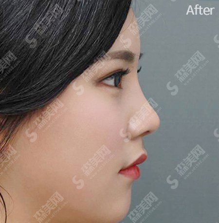 激光点痣让我告别瑕疵,激光点痣细节分享--点痣价格表曝光