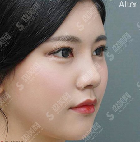 激光点痣让我告别瑕疵,激光点痣细节分享--点痣价格表曝光