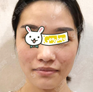 沧州华美和静港哪个好?附光子嫩肤案例对比图一览