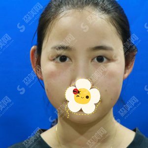 沈阳医大整形外科双眼皮案例分享---双眼皮整形价格一览