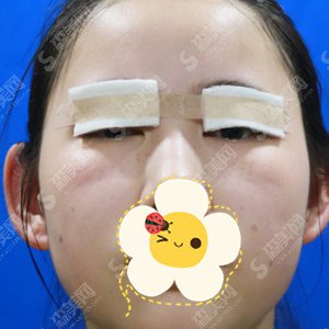 沈阳医大整形外科双眼皮案例分享---双眼皮整形价格一览