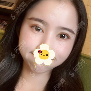 沈阳医大整形外科双眼皮案例分享---双眼皮整形价格一览