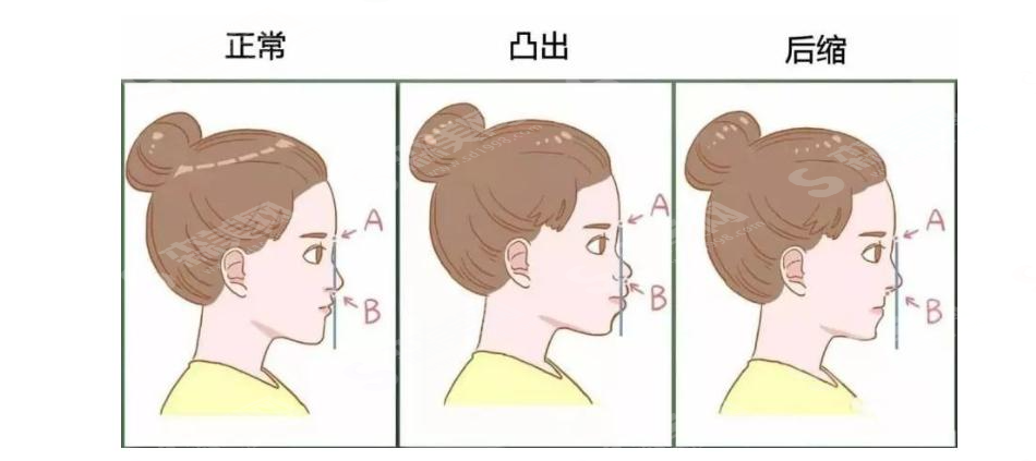 牙齿矫正值得做吗?分析牙齿矫正的利与弊