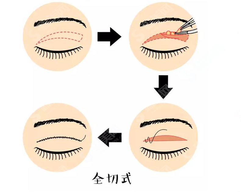 双眼皮怎么设计,才能看起来“眼里有星星”?