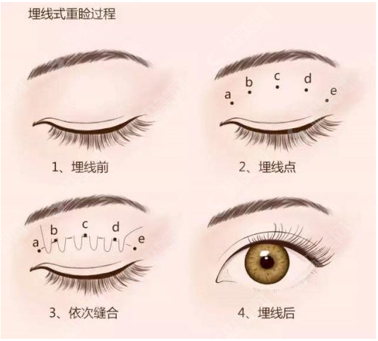 双眼皮如何做的灵动?专家提示别掉“坑”