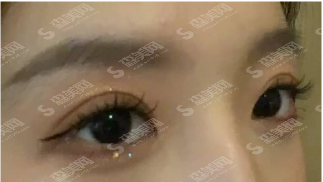 双眼皮如何做的灵动?专家提示别掉“坑”