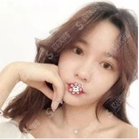 全切双眼皮恢复案例一览,看看是你想要的果吗?
