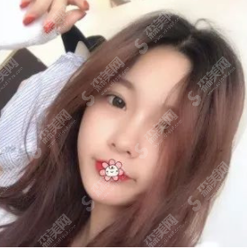 全切双眼皮恢复案例一览,看看是你想要的果吗?