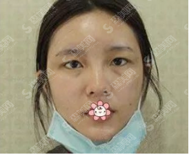 全切双眼皮恢复案例一览,看看是你想要的果吗?