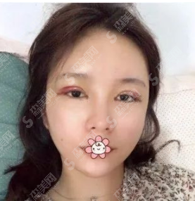全切双眼皮恢复案例一览,看看是你想要的果吗?