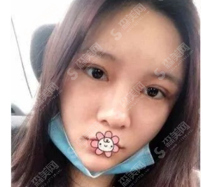 全切双眼皮恢复案例一览,看看是你想要的果吗?