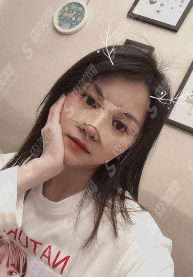 修志夫隆鼻多少钱？价格查询及假体隆鼻案例图片欣赏