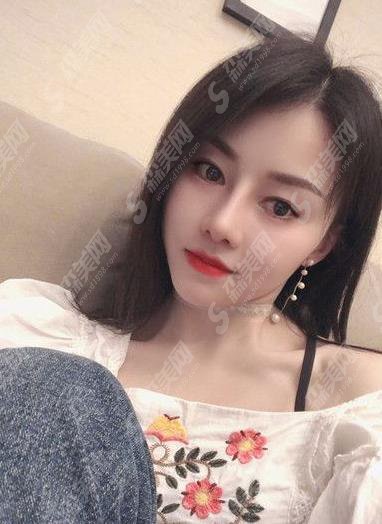 修志夫隆鼻多少钱？价格查询及假体隆鼻案例图片欣赏