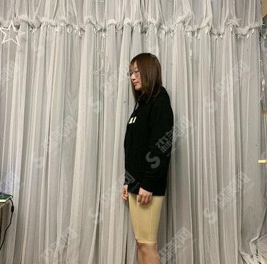 开封华忆医疗美容医院吸脂瘦腿案例前后对比图!分享吸脂瘦身整形价格标准
