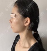 西京医院做双眼皮价格表2021，价格公布～双眼皮案例果图展示