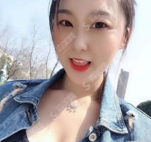 假体隆胸真人果案例分享,附隆胸价目表