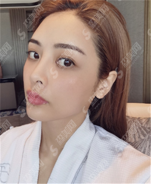 热玛吉瘦脸果好吗?它还适应哪些问题?