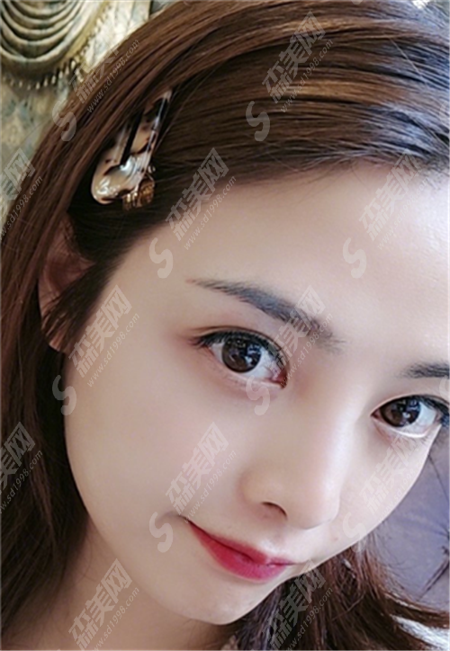 热玛吉瘦脸果好吗?它还适应哪些问题?