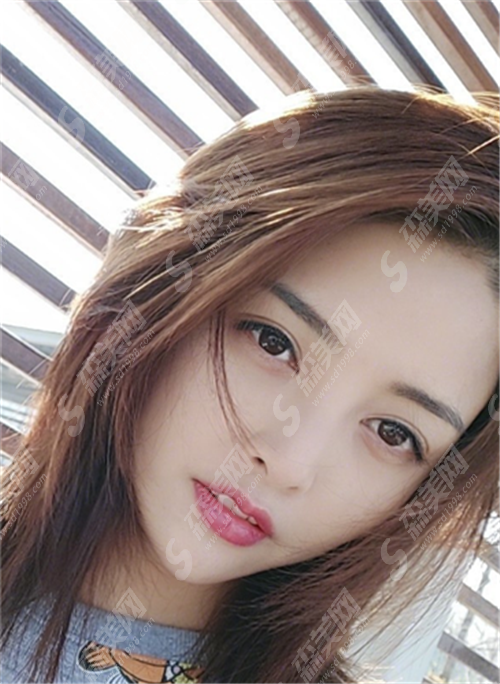 热玛吉瘦脸果好吗?它还适应哪些问题?