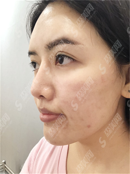 热玛吉一般多少岁开始做?用它去除皱术靠谱吗?