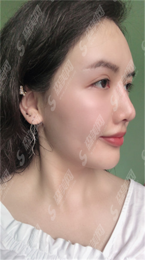 热玛吉一般多少岁开始做?用它去除皱术靠谱吗?