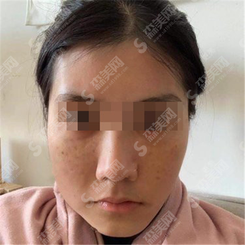 全脸热玛吉一次多少钱?到底贵不贵呢?