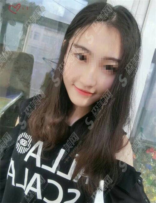 做热玛吉到底好不好?有什么优点?