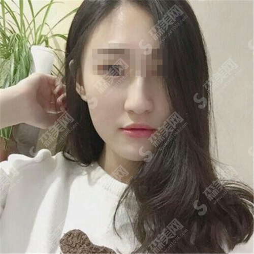 做热玛吉到底好不好?有什么优点?