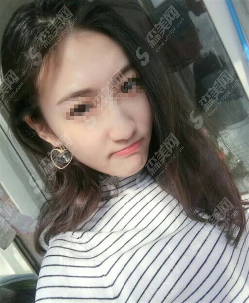 做热玛吉到底好不好?有什么优点?