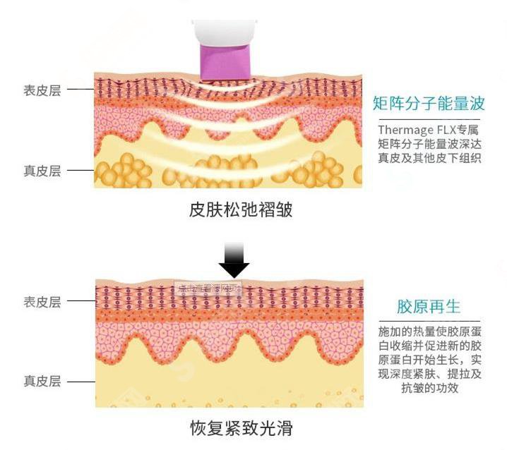 热玛吉FLX的果如何?疗能比上一代产品高多少?