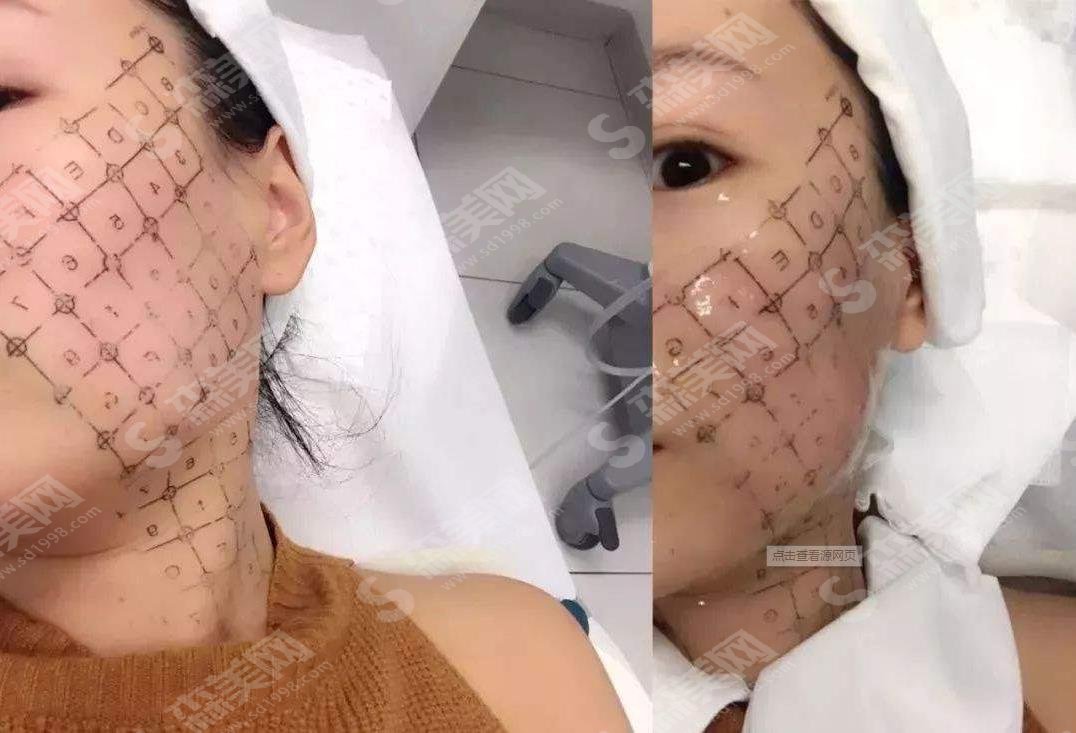 热玛吉FLX的果如何?疗能比上一代产品高多少?