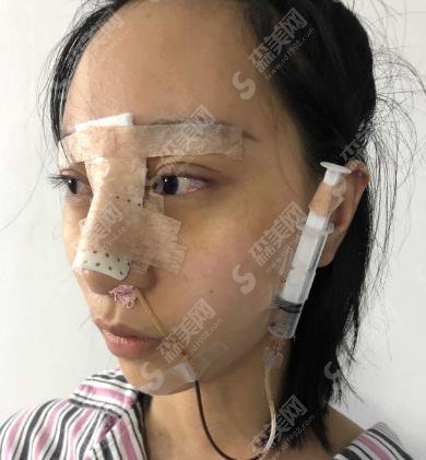 华仁整形美容医院隆鼻整形价格表出炉啦!含整形案例果对比照