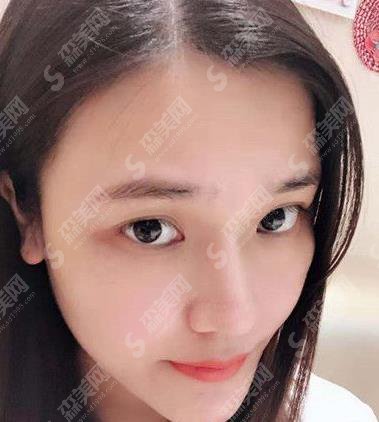 广州熙施整形医院切开双眼皮案例果图一览,2021眼部整形价格是多少钱