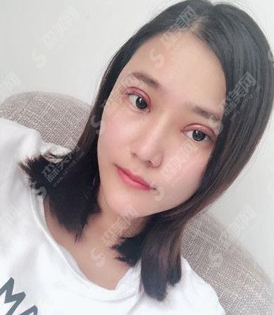 广州熙施整形医院切开双眼皮案例果图一览,2021眼部整形价格是多少钱