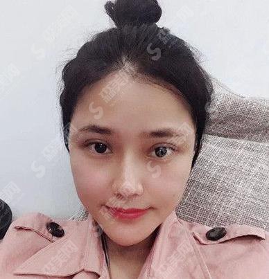 广州熙施整形医院切开双眼皮案例果图一览,2021眼部整形价格是多少钱