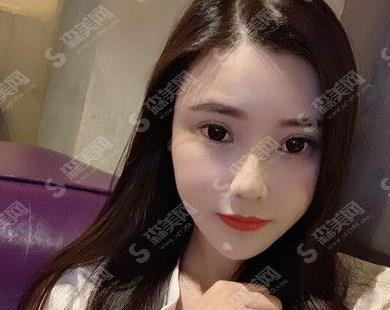 广州熙施整形医院切开双眼皮案例果图一览,2021眼部整形价格是多少钱