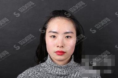 双眼皮整容医院哪家较靠谱?揭露上海华美双眼皮案例展示及价格公布