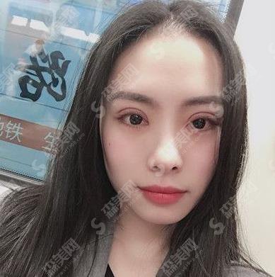 双眼皮整容医院哪家较靠谱?揭露上海华美双眼皮案例展示及价格公布