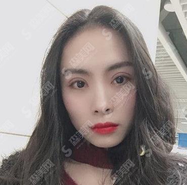 双眼皮整容医院哪家较靠谱?揭露上海华美双眼皮案例展示及价格公布